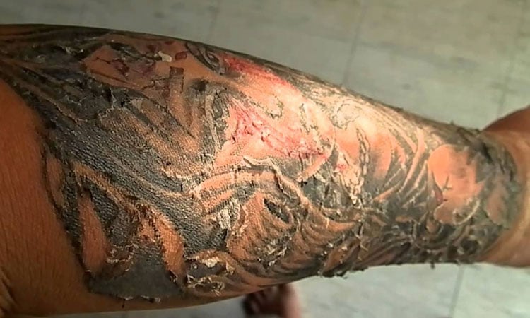 Tattoo Peeling